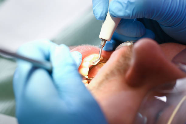 Best Emergency Root Canal Treatment in Untain View, MO