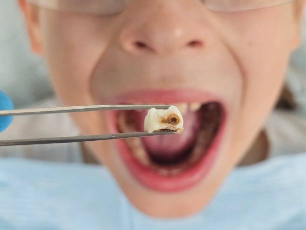 Best Emergency Dentist for Knocked-Out Tooth in Untain View, MO